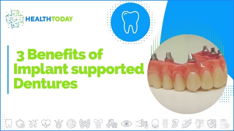 Calgary Dentures: 3 Benefits of Implant-Supported Dentures